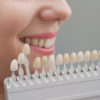 The Shading of Your Smile Matching Tooth Shade