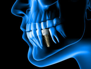 Dental Implants El Cajon, CA